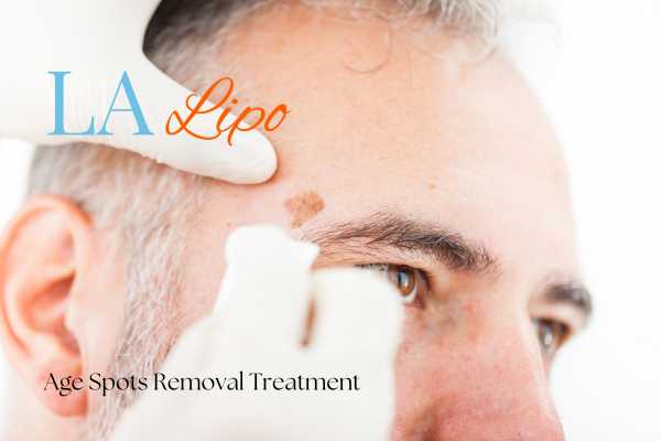 What Are the Most Effective Treatments for Age Spots Northwood?