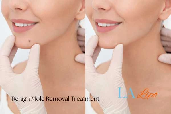 Before-and-after results following benign mole-removal treatment Northwood