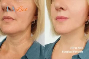 hi-fu for wrinkles Northwood before and after results