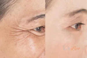 Before and after results of woman - HI-fu wrinkles reduction treatment Northwood