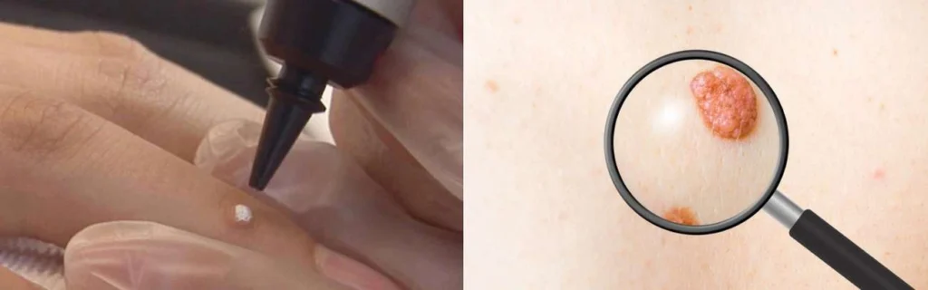 CryoPen practitioner Northwood assessing a benign mole before treatment
