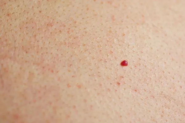 close up of a cherry angioma Northwood