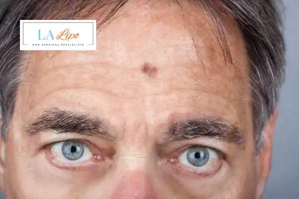 Solar Lentigo Removal Northwood image of man with mark on his forehead