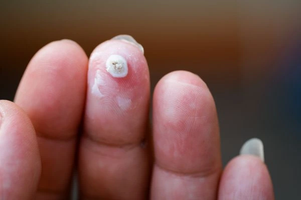 wart on person finger - cryotherapy to treat from LA LIPO Northwood