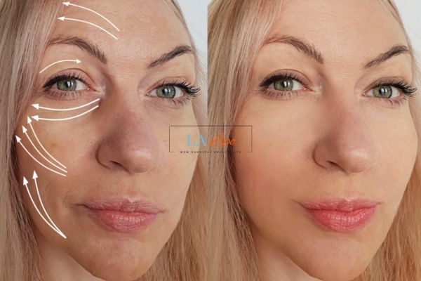 Morpheus 8 results Northwood face lift.