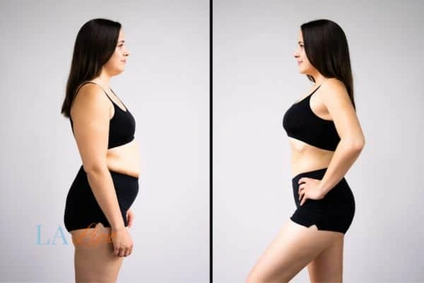 Picture of womans before and after using LA-EMS body sculpting to improve her core strength Northwood