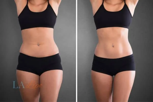 before and after results of non-surgical treatment to help a woman's body image and mental health Northwood