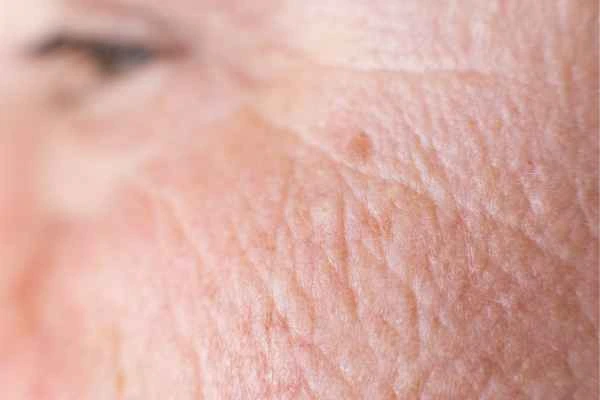 close up picture of a woman's face showing an age spot Northwood