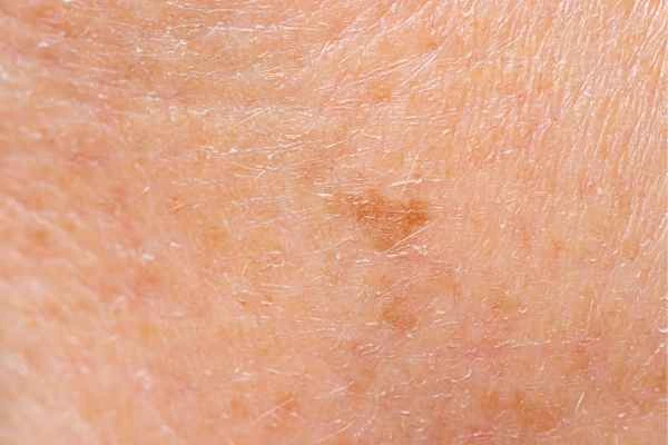 close up picture of age spots Northwood