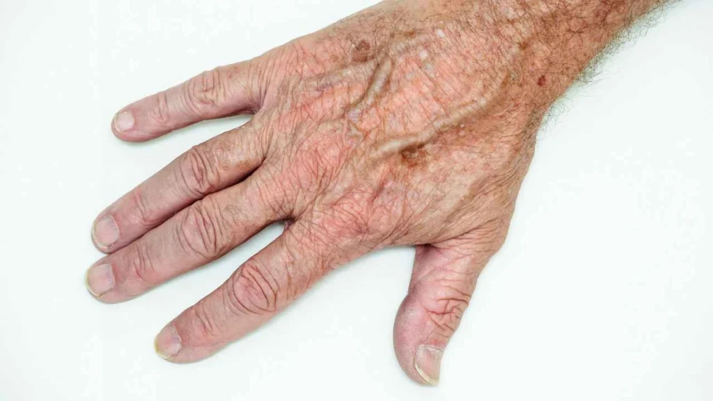 Male hand showing age spot Northwood